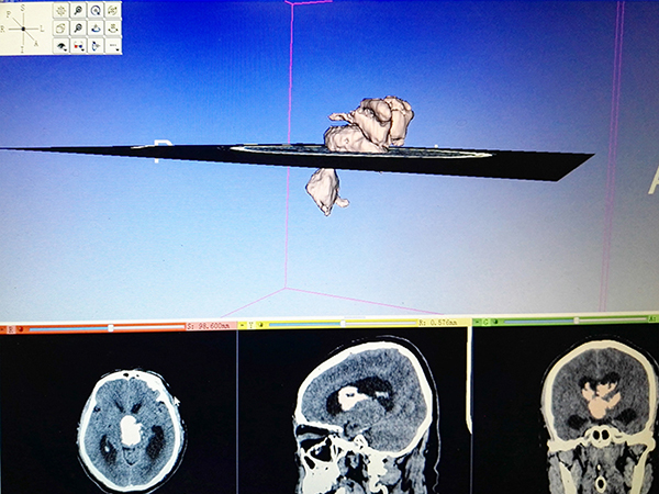錦州市中心醫(yī)院神經(jīng)外科完成東北地區(qū)首例3D Slicer手機(jī)軟件設(shè)備導(dǎo)航下內(nèi)鏡輔助腦血腫 ...