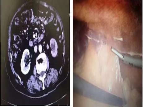 遼西首例“一體位腹腔鏡下左腎盂癌根治術(shù)”成功