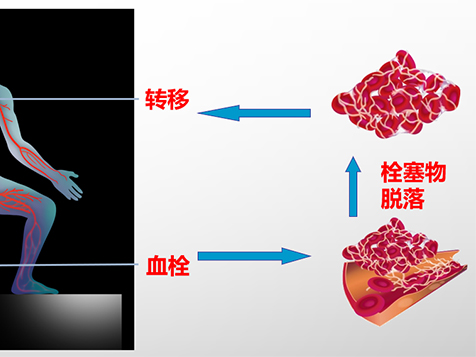 優(yōu)勢學科|錦州市中心醫(yī)院心血管內三科成功救治一名高危肺動脈栓塞患者